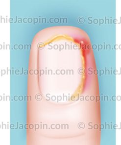 ONGLE INCARNÉ