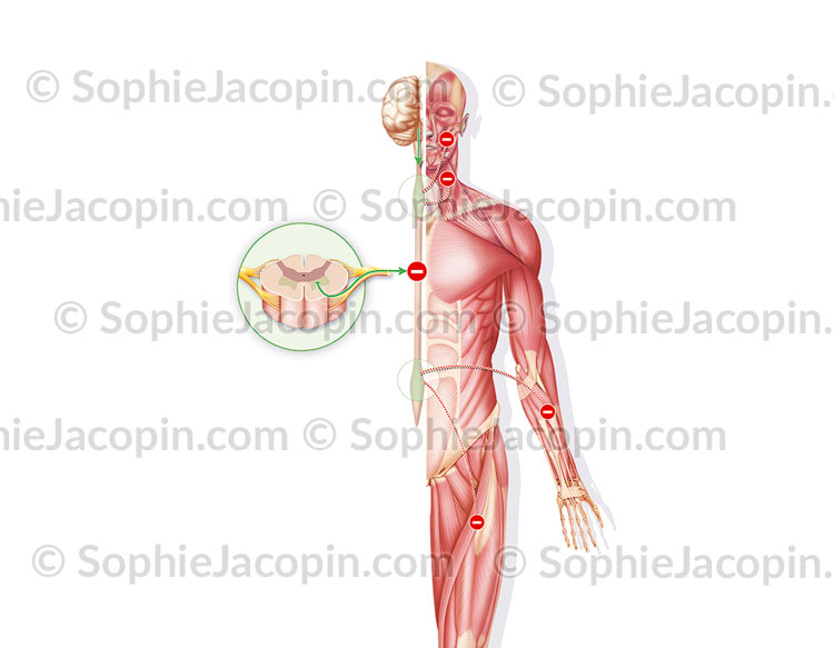 MALADIE DE CHARCOT – Image 2