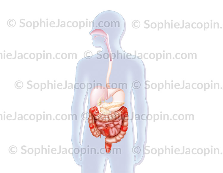 MALADIE DE CROHN