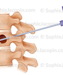 CYPHOPLASTIE, INJECTION DU CIMENT