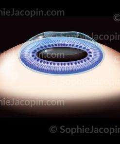 PHOTOKÉRATECTOMIE-PKR